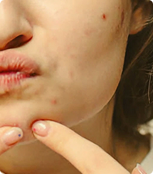 Giải pháp da mụn